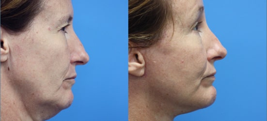 Chin Implant before and after