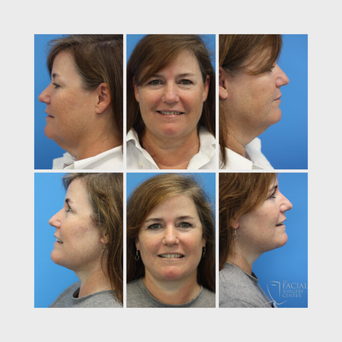 Facelift Liposuction of the Neck and Jowls