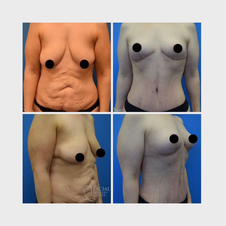 Body Contouring -bilateral breast lift (mastopexy) and tummy tuck (lipoabdominoplasty) Mast