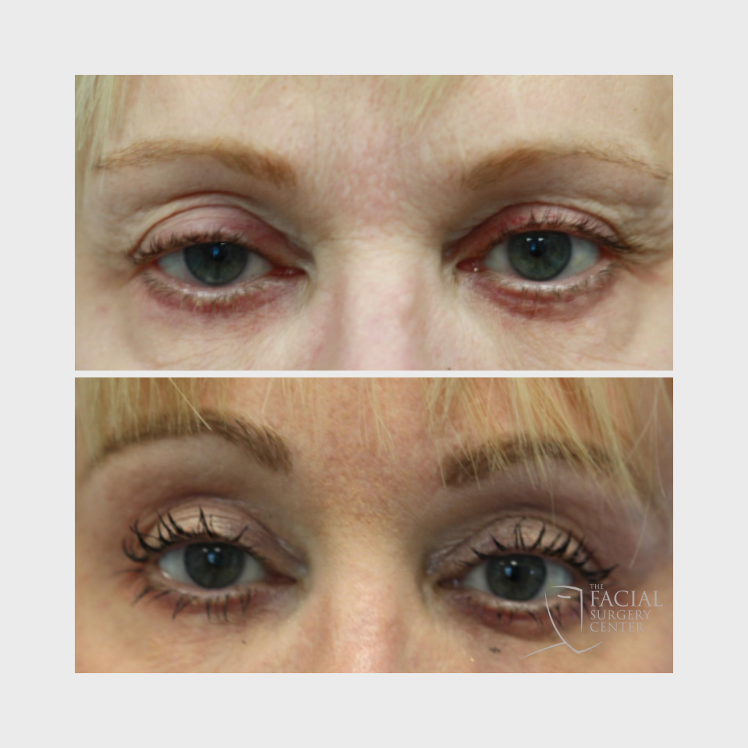 Endoscopic BrowLift