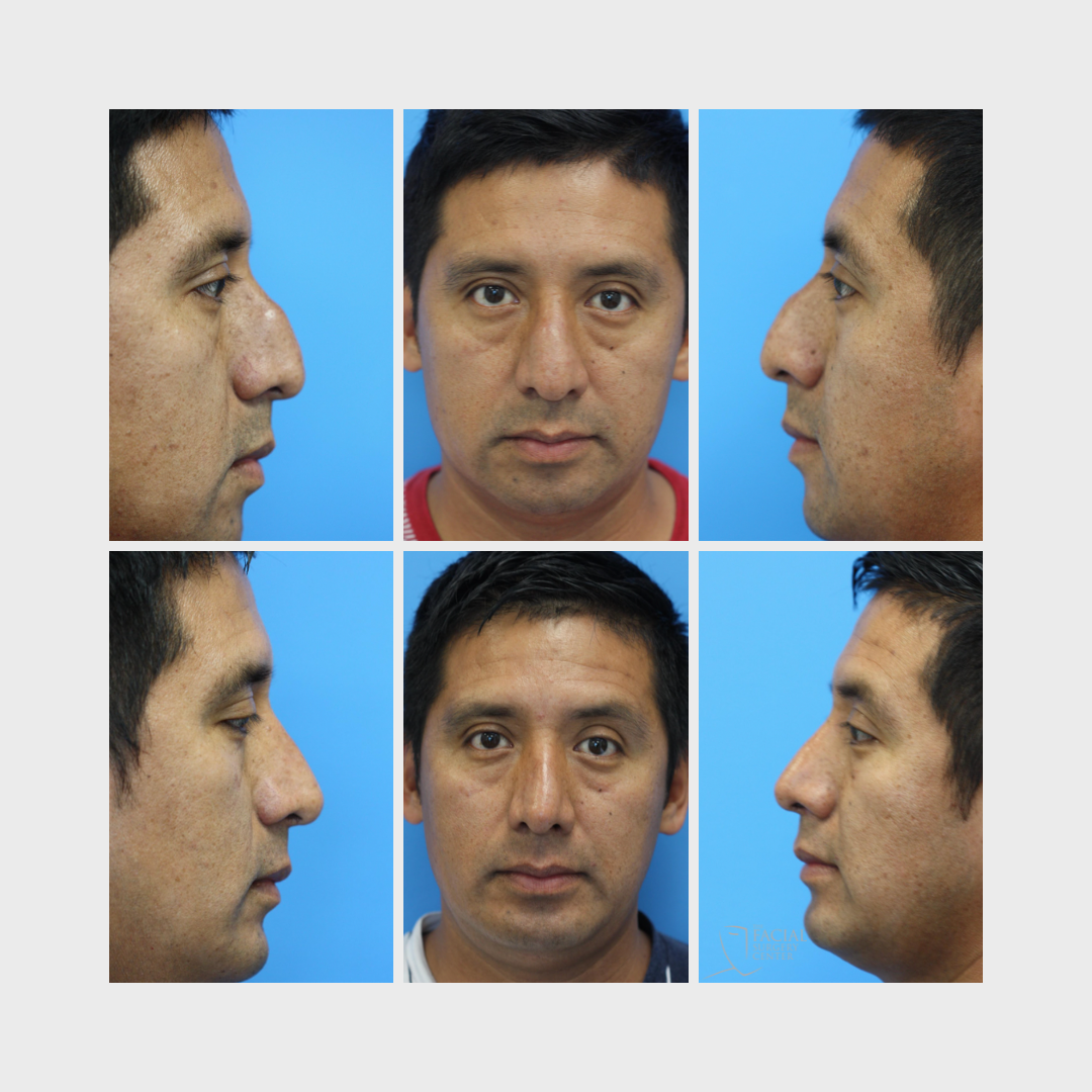 Rhinoplasty (2)