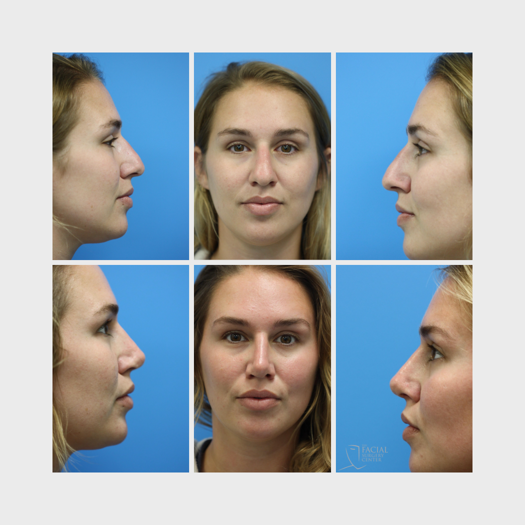 Rhinoplasty (3)