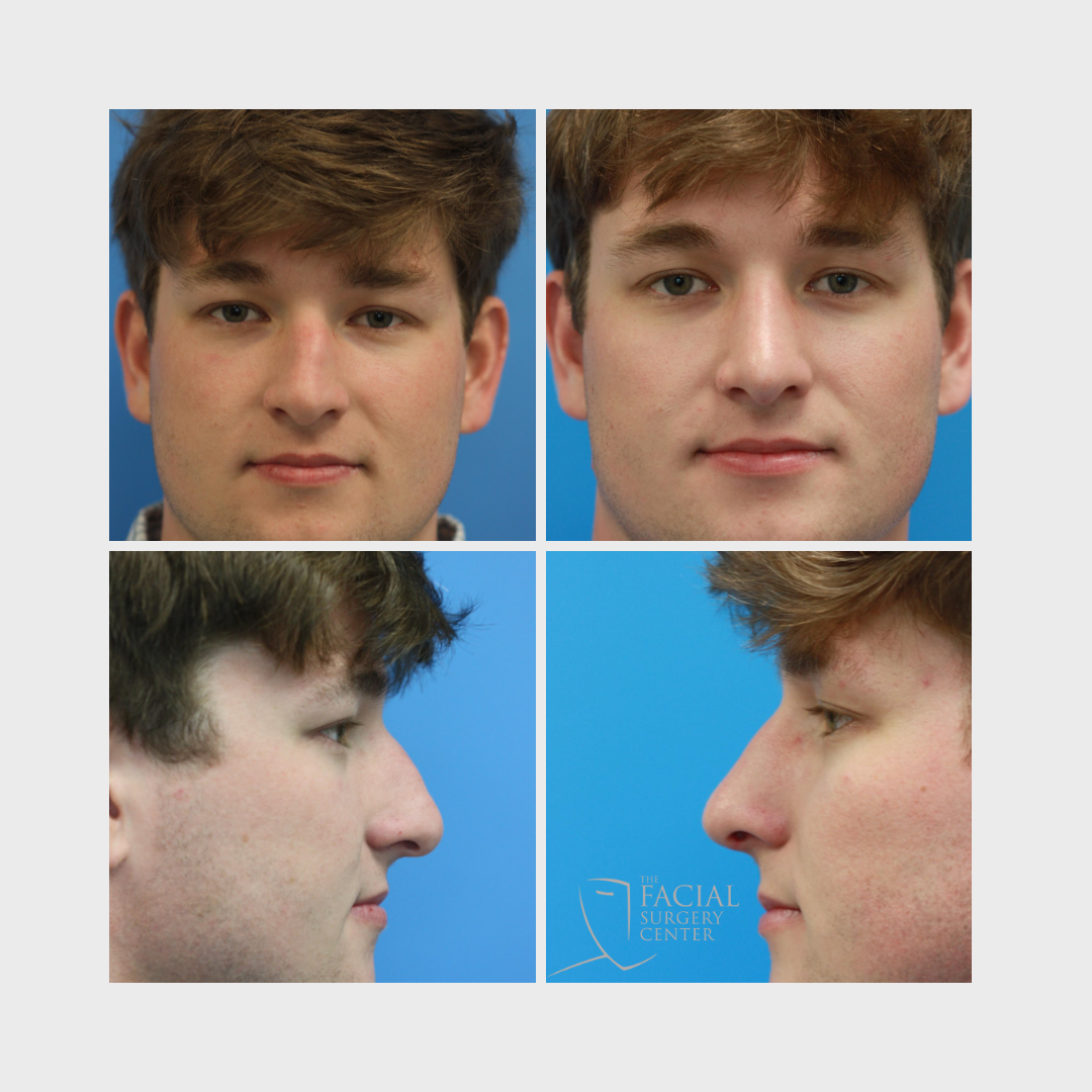 Rhinoplasty (4)