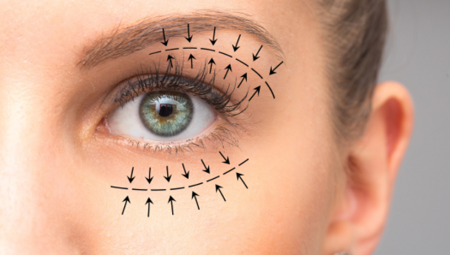Blepharoplasty