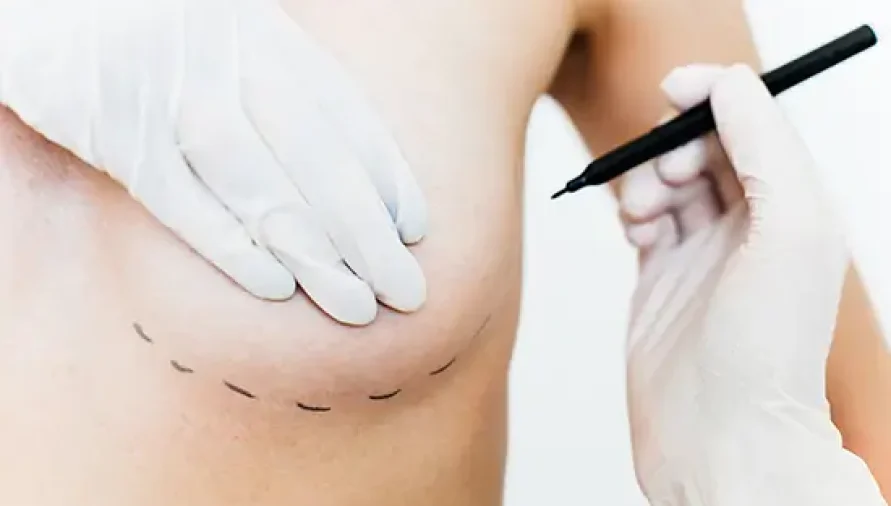 Breast-Reconstruction