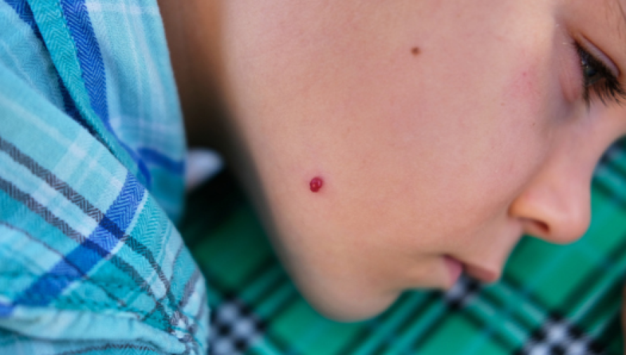 Hemangioma Treatment