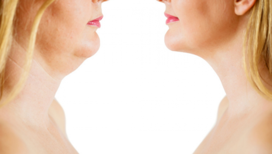 Liposuction of Neck and Jowls