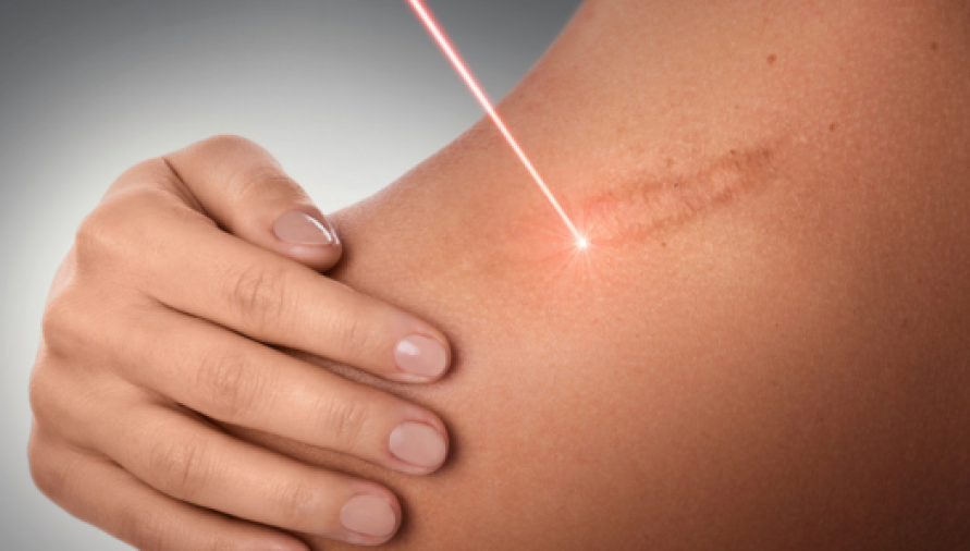 Other Laser Treatment