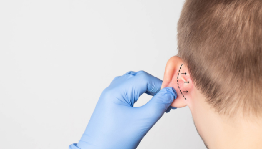Otoplasty