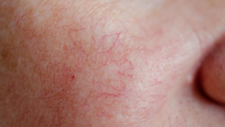 Vascular Lesion Revision